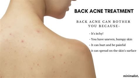 back acne diagram 